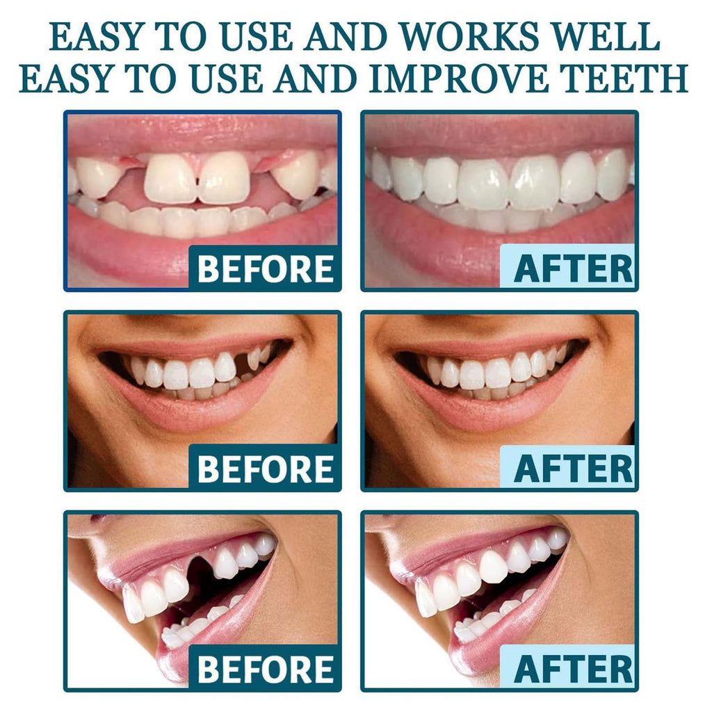 Clip on Veneers Silicone Kit for Both Upper and Lower (3Set) W69770